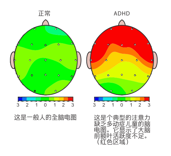 多動癥